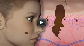 Observez une excroissance de peau